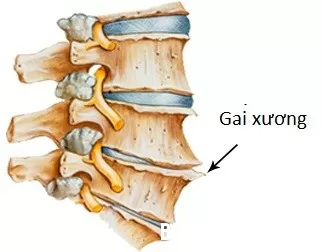 Những quan niệm sai lầm trong điều trị gai cột sống