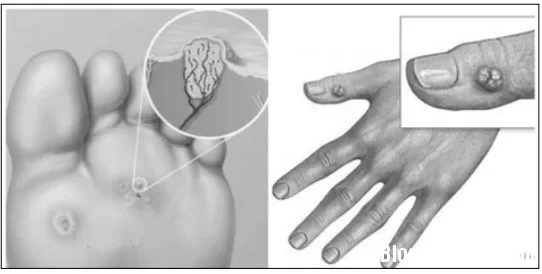 Thuốc điều trị mụn cóc