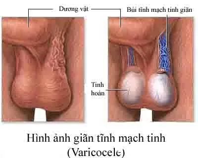 Giãn tĩnh mạch thừng tinh chớ có xem thường