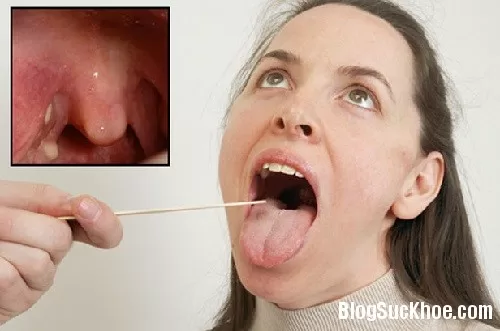 Hỗn hợp trị viêm họng, viêm phế quản hiệu quả hơn gặp bác sĩ