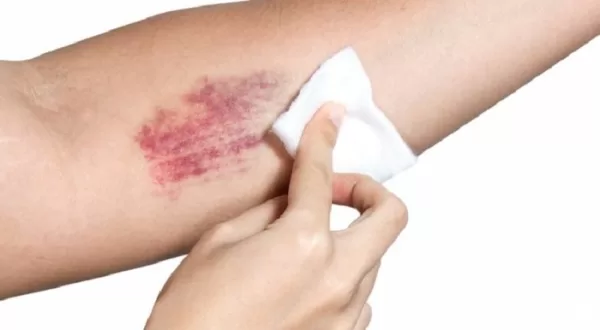 Mẹo làm giảm vết bầm tím trên cơ thể