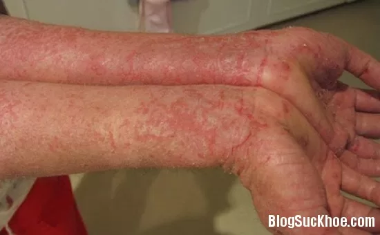 Những dạng viêm da thường gặp do thay đổi thời tiết