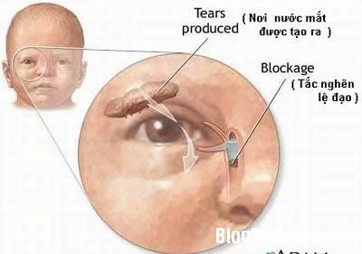 Xử trí tắc tuyến lệ ở trẻ sơ sinh