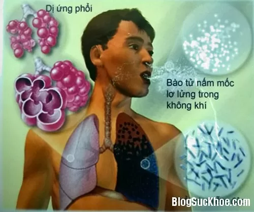 Bệnh nấm phổi