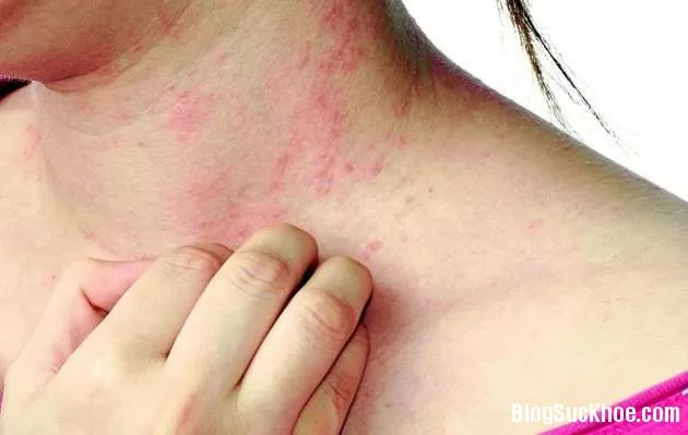 Dị ứng thuốc và những điều cần lưu ý