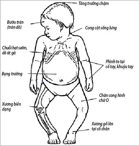 Phòng ngừa còi xương ở trẻ nhỏ