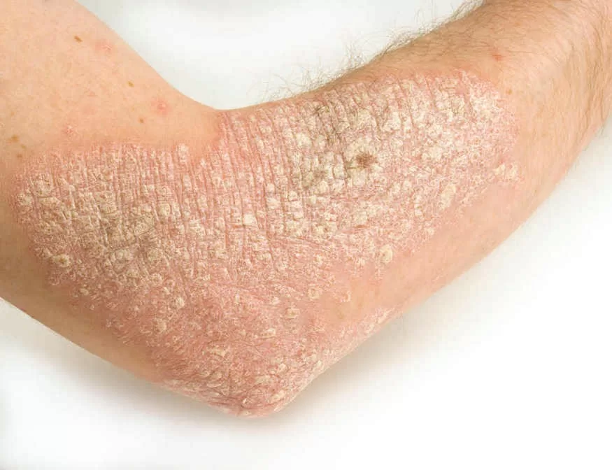 Điều trị bệnh vảy nến