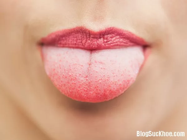 Cảnh báo bệnh qua màu sắc của lưỡi