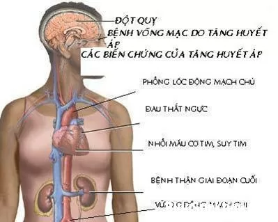 Những nguyên tắc vàng ngăn ngừa đột quỵ