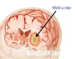 Nguyên nhân gây u não hàng đầu bạn cần biết