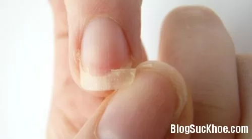 Dấu hiệu báo bệnh từ móng tay
