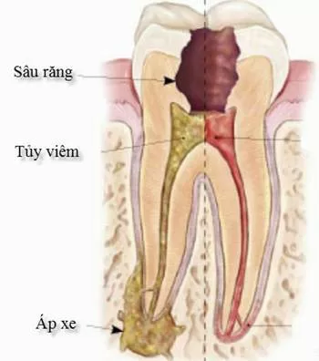Những chú ý trong quá trình phục hồi thân răng sau điều trị