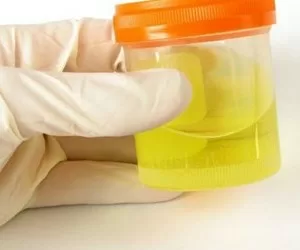 Cách để xác định bệnh bằng nước tiểu