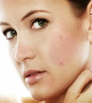 Khi bị mụn trứng cá nên hạn chế những loại thực phẩm nào?