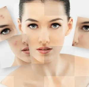 Những điều mà bạn chưa biết về mụn và cách trị mụn