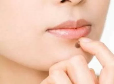 Những nốt ruồi khai vận nhất định không nên tẩy xóa