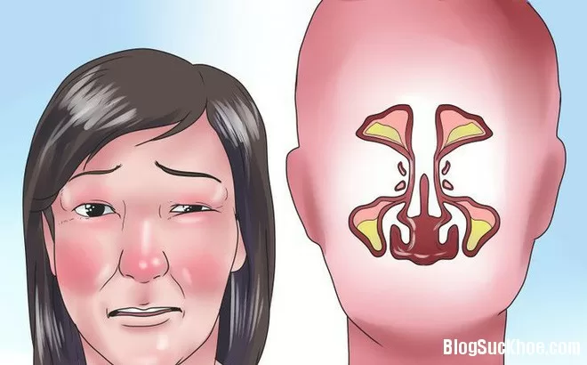 Mẹo chữa nghẹt mũi không cần dùng thuốc