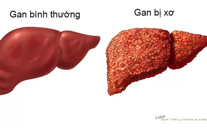 Tránh xa 5 nguyên nhân này kẻo xơ gan gõ cửa