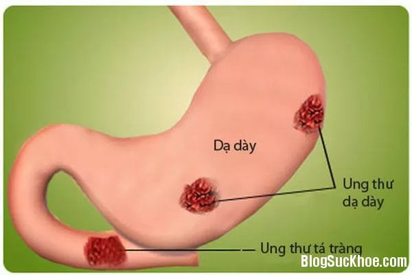 4 loại bệnh ung thư gây đau đớn nhất