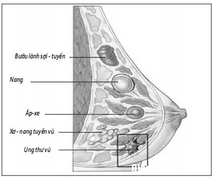Bệnh ở vú chưa hẳn là ác tính