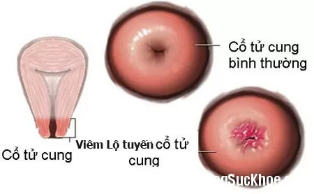 Muốn có thai cần chữa viêm lộ tuyến trước