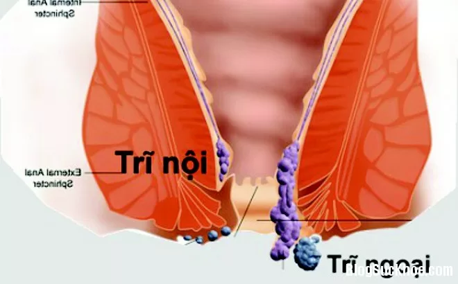 Bài thuốc chữa bệnh trĩ của người Ấn Độ