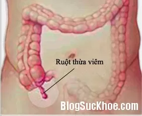 Biểu hiện của viêm ruột thừa