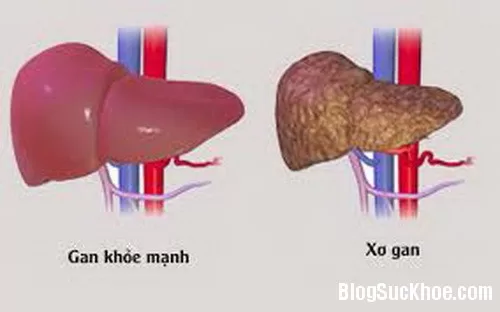 12 bài thuốc chữa bệnh gan do rượu