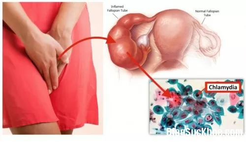 Những điều cần biết về Chlamydia