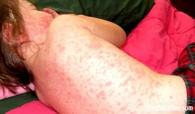 Dấu hiệu nhận biết sốt xuất huyết Dengue