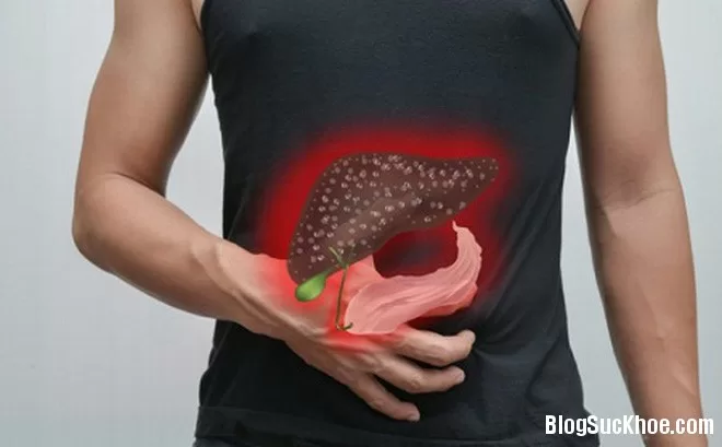 Triệu chứng bệnh gan nhiễm mỡ