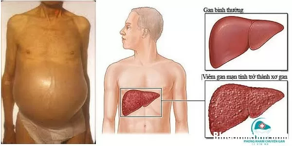 Những kiêng kỵ ăn uống người bị viêm gan B cần nhớ