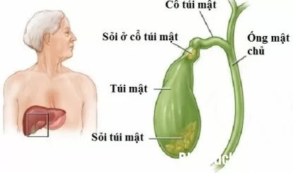 Bị sỏi mật nên ăn uống như thế nào?