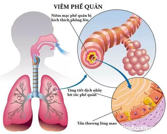 7 cách chữa tự nhiên không cần thuốc chữa viêm phế quản, ho dai dẳng có đờm