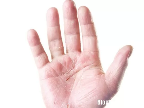 7 sự thật về bệnh vảy nến khiến bạn ngạc nhiên