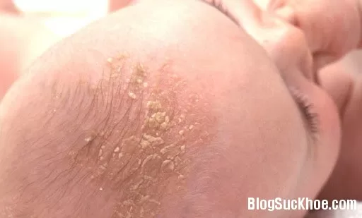Đông y chữa chốc đầu ở trẻ nhỏ