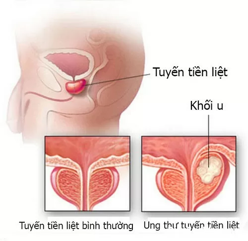 Ung thư tuyến tiền liệt có những dấu hiệu gì?