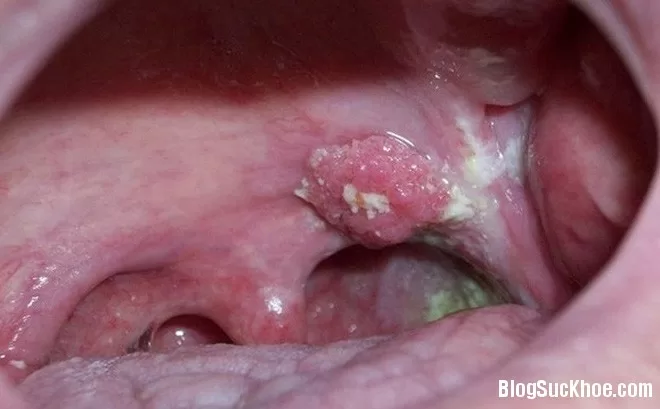 5 dấu hiệu cần nhớ liên quan đến ung thư vòm họng