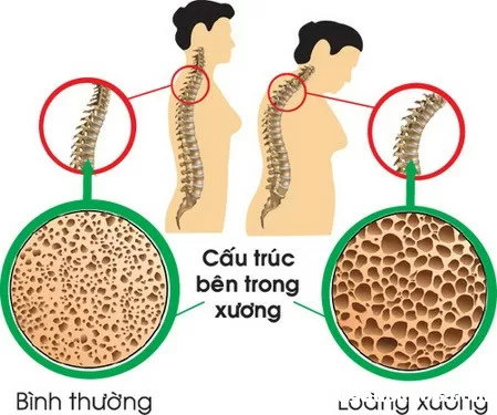 3 bài thuốc tiêu biểu chữa loãng xương