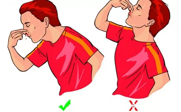 Cách xử lý đúng khi bị chảy máu cam