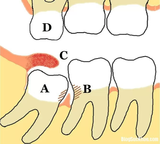 Đau khi mọc răng khôn, chỉ 5 phút cơn đau sẽ dứt