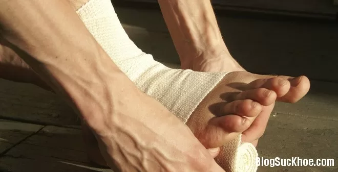 Những mẹo hay chữa bong gân bạn không nên bỏ qua