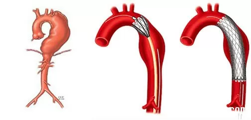 Triệu chứng nhận biết phình động mạch chủ