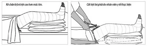 Cách chăm sóc sau bó bột trị gãy xương