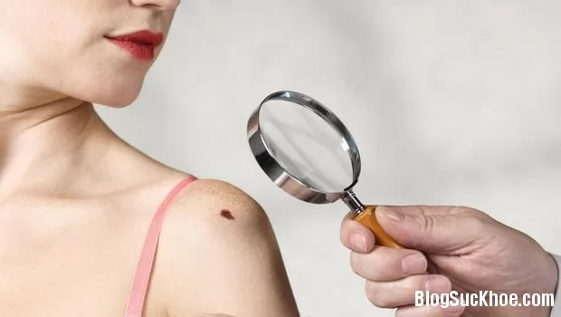 Liệu pháp thiên nhiên giúp loại bỏ nốt ruồi