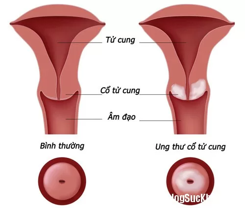 7 dấu hiệu ung thư cổ tử cung nguy hiểm