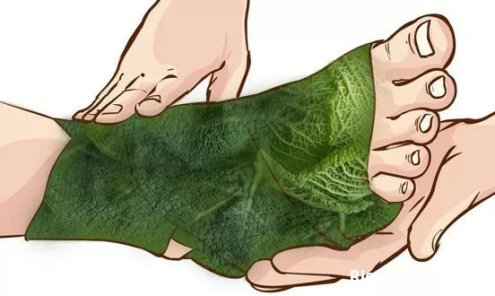 Các cách điều trị đau gút (Gout) bằng lá bắp cải