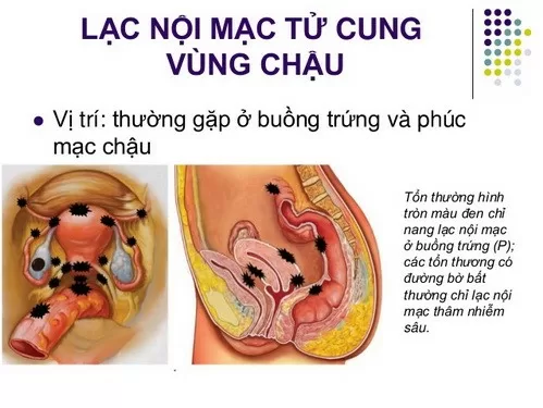 Nóng vùng bụng dưới là dấu hiệu bệnh gì?