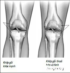 Đau đầu gối - Nguyên nhân do đâu ?