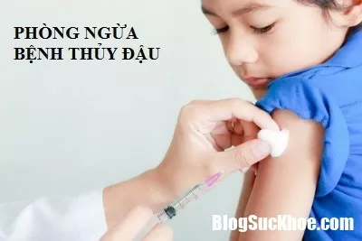 Đã tiêm phòng thủy đậu sao vẫn bị bệnh?